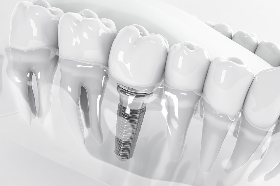 歯を失った際の選択肢の一つ「インプラント治療」