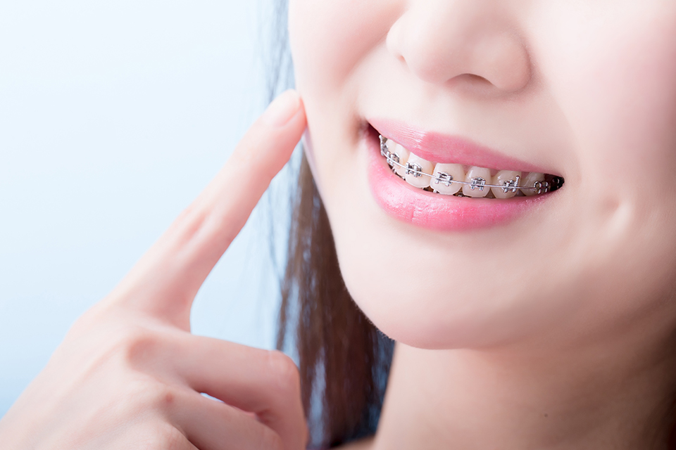 矯正治療中は虫歯・歯周病になりやすいため、予防が大切
