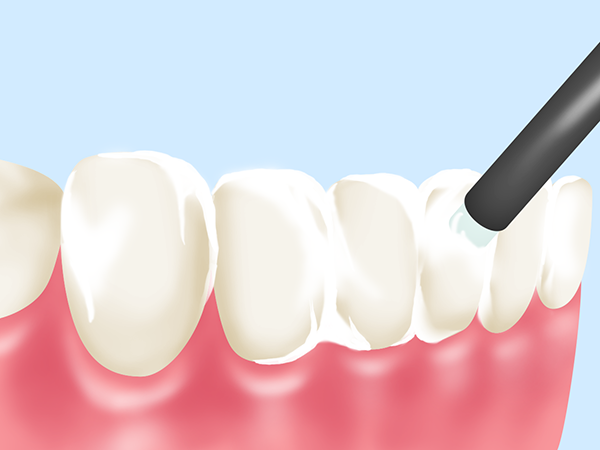 虫歯予防のためのフッ素塗布