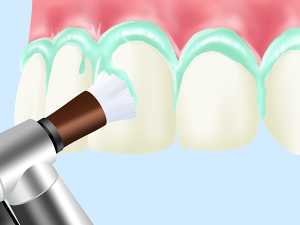 専門家による歯のクリーニング（PMTC）
